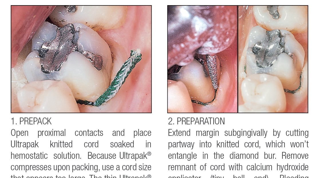 Mastering Retraction Cord Placement